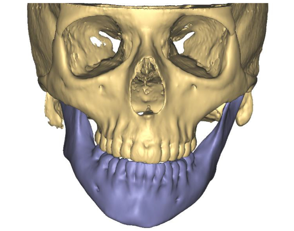 Pre-operative 3D CT image demonstrating poor orthognathic position and lower facial deformities as a result of juvenile idiopathic arthritis